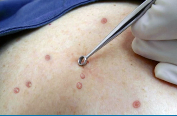 Molusco contagioso - Neoderm - Dermatólogos Guatemala